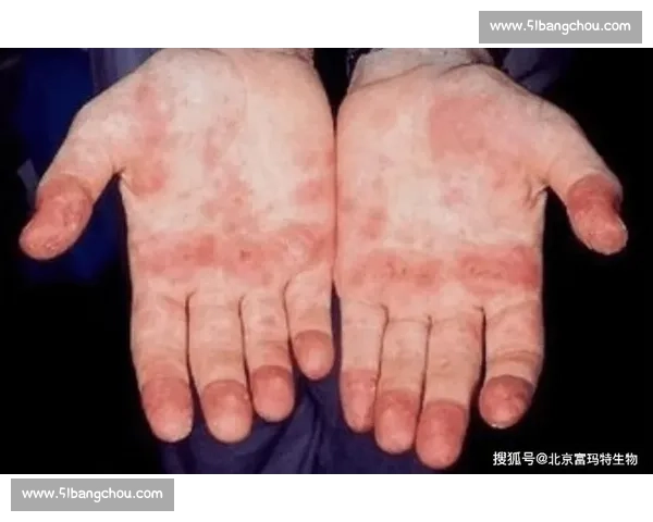 红斑狼疮的早期识别诊治策略与多系统损伤防控新进展